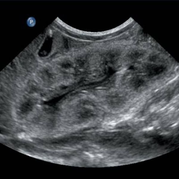 ultrasonido renal